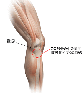 なかなか治らない膝内側の痛みの原因とは 横浜で鍼灸と言えばオリンピック選手や世界選手権金メダリストも通う土井治療院へ