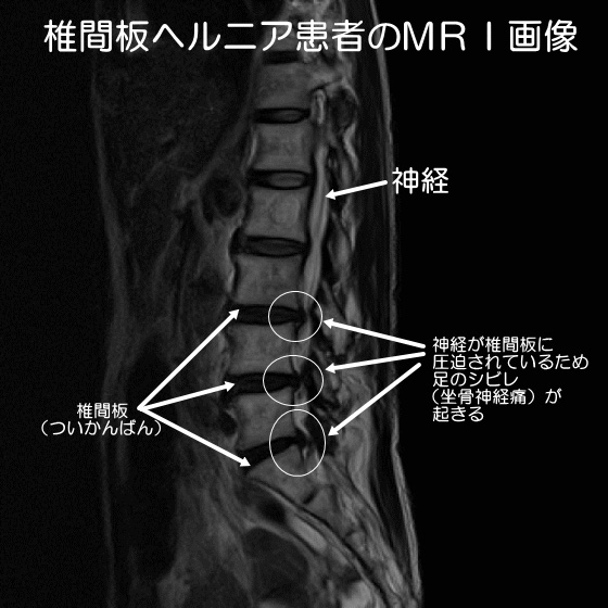 椎間板ヘルニア患者のMRI画像