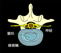 椎間板ヘルニア2