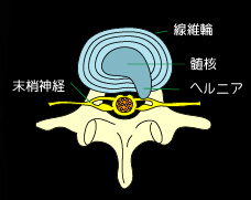 椎間板ヘルニア4