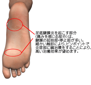 足底腱膜炎 足底筋膜炎 の治療 横浜で鍼灸と言えばオリンピック選手や世界選手権金メダリストも通う土井治療院へ