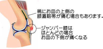 ジャンパー膝の詳細図3