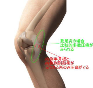 レントゲンではわからない膝内側の痛み 横浜で鍼灸と言えばオリンピック選手や世界選手権金メダリストも通う土井治療院へ