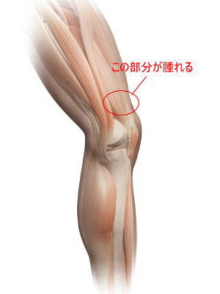 膝の上が腫れるのはなぜ 横浜で鍼灸と言えばオリンピック選手や世界選手権金メダリストも通う土井治療院へ