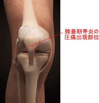 お皿の下の痛み 膝蓋靭帯炎ではない 横浜で鍼灸と言えばオリンピック選手や世界選手権金メダリストも通う土井治療院へ